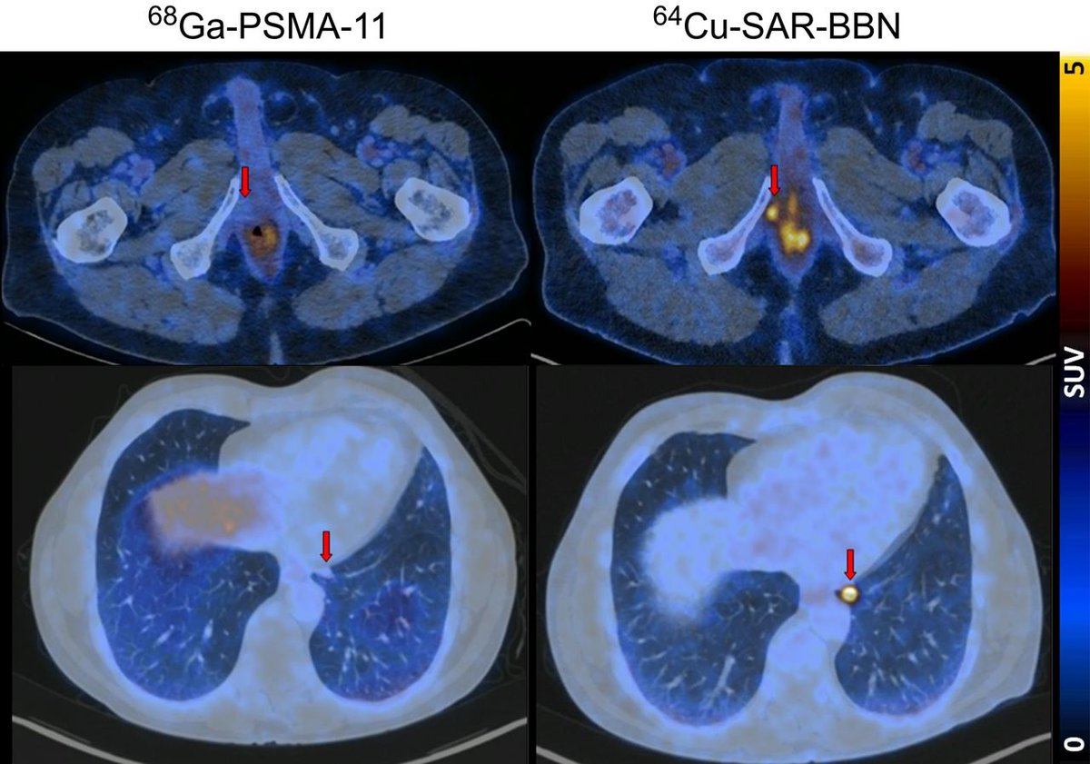JournalofNucMed's tweet image. Is Bombesin PET/CT imaging helpful in PSMA negative prostate cancer? ow.ly/QHlO50SWG5k

#NuclearMedicine #ProstateCancer #MolecularImaging @DrLouiseEmmett