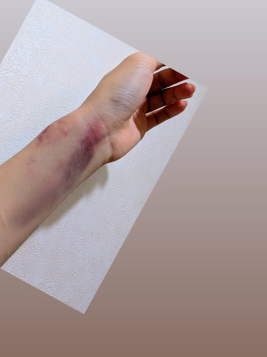 無事に退院も出来まして死ぬほど元気なんですが手術より、点滴が下手すぎて毎日ブチ切れてます。笑