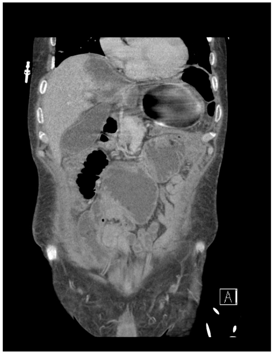 SurgicalTD_MDPI's tweet photo. #mdpiSTD Our latest paper is out: The Ileojejunal Bypass: The Forgotten Procedure by Caroline Mercedes Sobotta et al. https://t.co/Dvtl1a8Ql8
@MDPIOpenAccess @Scilit_ @MediPharma_MDPI @KlinikumStutt
#IleojejunalBypass #Surgery #MedicalResearch #Health #Procedure https://t.co/OqDRTWYhKQ