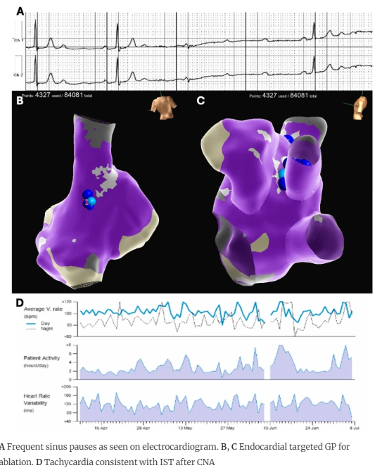 JICE (@jice_ep) on Twitter photo 🚨New #FreeRead in <a href="/JICE_EP/">JICE</a>
Post-Procedural Inappropriate Sinus Tachycardia after CNA for Malignant Swallow Syncope
by <a href="/NChelikam/">Nikhila Chelikam MBBS,MSCR</a>, Aashish Katapadi, <a href="/krishpothineni/">Krishna Pothineni</a>, <a href="/drrakeshg1/">Rakesh Gopinath</a>, <a href="/rajeshkabramd/">Rajesh Kabra</a>, <a href="/RangaraoTummala/">Rangarao Tummala</a>, Andrea Yang, <a href="/DJ_Lakkireddy/">DJ Lakkireddy</a> & <a href="/djdardenMD/">Doug Darden</a>
#EPeeps 🚨New #FreeRead in <a href="/JICE_EP/">JICE</a>
Post-Procedural Inappropriate Sinus Tachycardia after CNA for Malignant Swallow Syncope
by <a href="/NChelikam/">Nikhila Chelikam MBBS,MSCR</a>, Aashish Katapadi, <a href="/krishpothineni/">Krishna Pothineni</a>, <a href="/drrakeshg1/">Rakesh Gopinath</a>, <a href="/rajeshkabramd/">Rajesh Kabra</a>, <a href="/RangaraoTummala/">Rangarao Tummala</a>, Andrea Yang, <a href="/DJ_Lakkireddy/">DJ Lakkireddy</a> & <a href="/djdardenMD/">Doug Darden</a>
#EPeeps