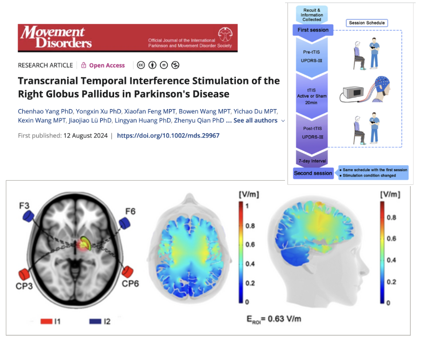 neuromodulate's tweet photo. Transcranial🧠⚡temporal interference stimulation (tTIS) - novel nonneurosurgical alternative to #DBS
https://t.co/CQo8tWLeoF
@DBSsocietyorg @IntlNeuromod
#tTIS #neurology #neurosurgery #Parkinsons #movementdisorders #brainmachine #innovation #future #noninvasive #neuromodulation https://t.co/ZTuTVHFTqS