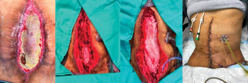 ThiemePlasticS's tweet photo. This 4-year follow-up by @NicholasOleckMD of synchronous #abdominal wall #vascular composite #allotransplantation (AW-VCA) and #smallbowel transplantation reveals novel insights and innovations in abdominal wall VCA:
https://t.co/20c6OAbWO6
#plasticsurgery   #MedTwitter https://t.co/7Dp2XGQcex