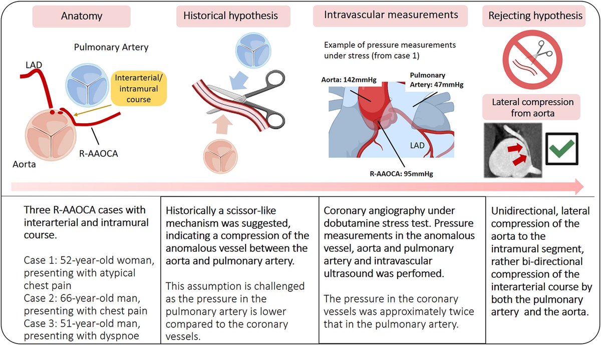 Christoph Gräni (@chrisgraeni) on Twitter photo 🚨 Rethink #Anomalous Aortic Origin of Coronary Artery #AAOCA + #interarterial course.
🚫No 'scissor-like' compression (unidirectional intramural compression by the aorta)
🚫Not all ‚malignant‘ (relevant)
<a href="/RaberLorenz/">Lorenz Räber, MD PhD</a> <a href="/biglermarius/">Marius Reto Bigler</a>
<a href="/snsf_ch/">Swiss National Science Foundation</a> <a href="/EHJCREiC/">EHJCaseReports Editor-in-Chief</a>
shorturl.at/VdL1x 🚨 Rethink #Anomalous Aortic Origin of Coronary Artery #AAOCA + #interarterial course.
🚫No 'scissor-like' compression (unidirectional intramural compression by the aorta)
🚫Not all ‚malignant‘ (relevant)
<a href="/RaberLorenz/">Lorenz Räber, MD PhD</a> <a href="/biglermarius/">Marius Reto Bigler</a>
<a href="/snsf_ch/">Swiss National Science Foundation</a> <a href="/EHJCREiC/">EHJCaseReports Editor-in-Chief</a>
shorturl.at/VdL1x
