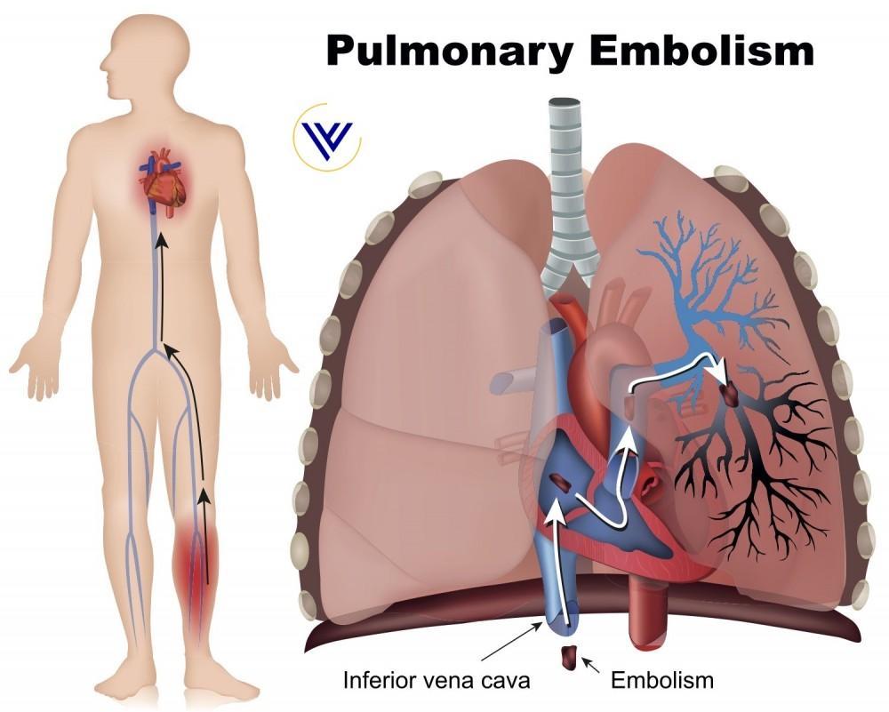 Not moving around or being sedentary is perhaps one of the common dangerous lifestyle.

With remote jobs and work from home. These risks have become exponential. 

Firstly, As you move around and take walks. your leg muscles have been designed to squeeze blood and push it back to
