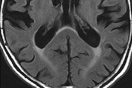 DocNavarrow's tweet photo. 💡Diabetes is linked to FLAIR hyperintensities in the anterior callosal splenium, which correlates with mild cognitive impairment🧠👴Could this be a new biomarker for cognitive decline?🤔 https://t.co/SHDBU8qaVy