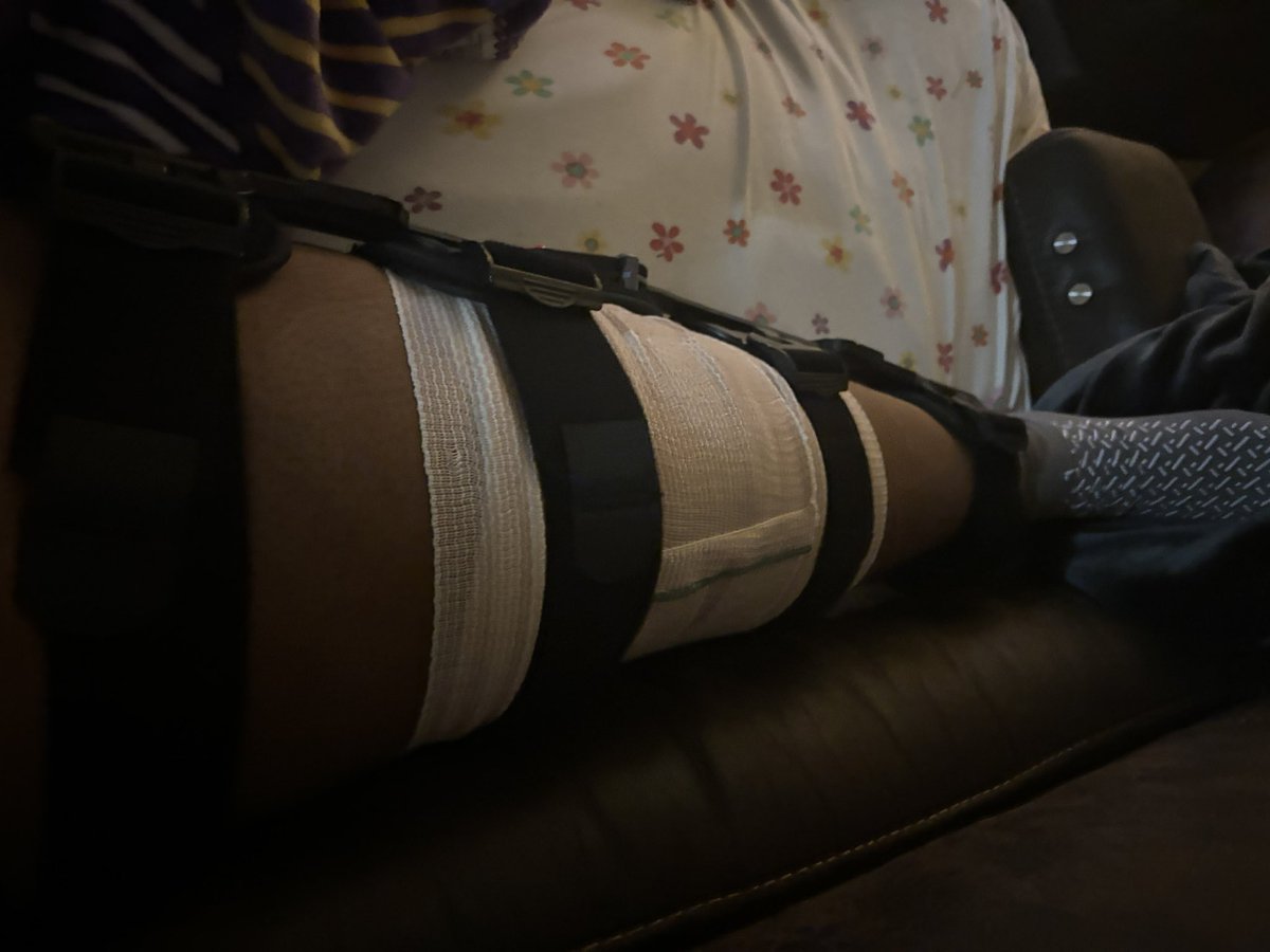 EmersonStephe10's tweet photo. You never think it’s gonna happen until it happened to you! Unfortunately June 20th I tore my acl at a Paris JUCO camp. Yesterday August 12th I had my acl surgery. I will be back February 25’😇🙏🏾 https://t.co/w84IpGooa0