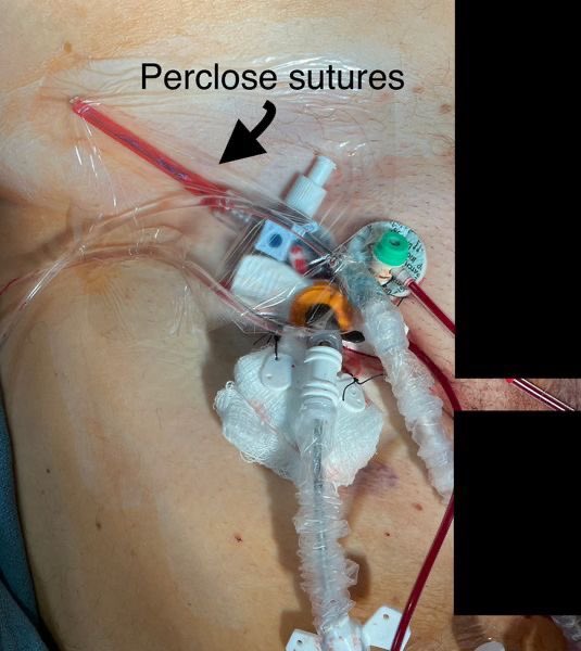 Murmur_MD's tweet image. A wonderful #CathLabHack from @HadyLichaaMD on keeping your Perclose Sutures around a large bore sheath clean!

What is your method? #CardioTwitter