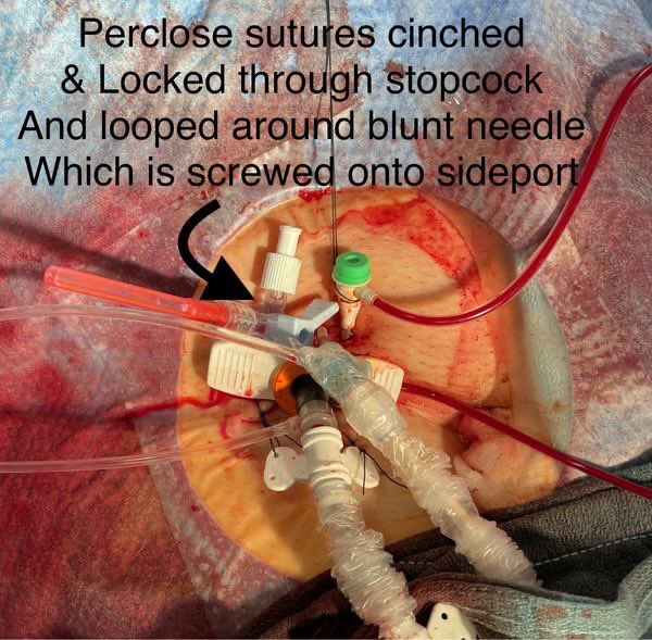 Murmur_MD's tweet image. A wonderful #CathLabHack from @HadyLichaaMD on keeping your Perclose Sutures around a large bore sheath clean!

What is your method? #CardioTwitter