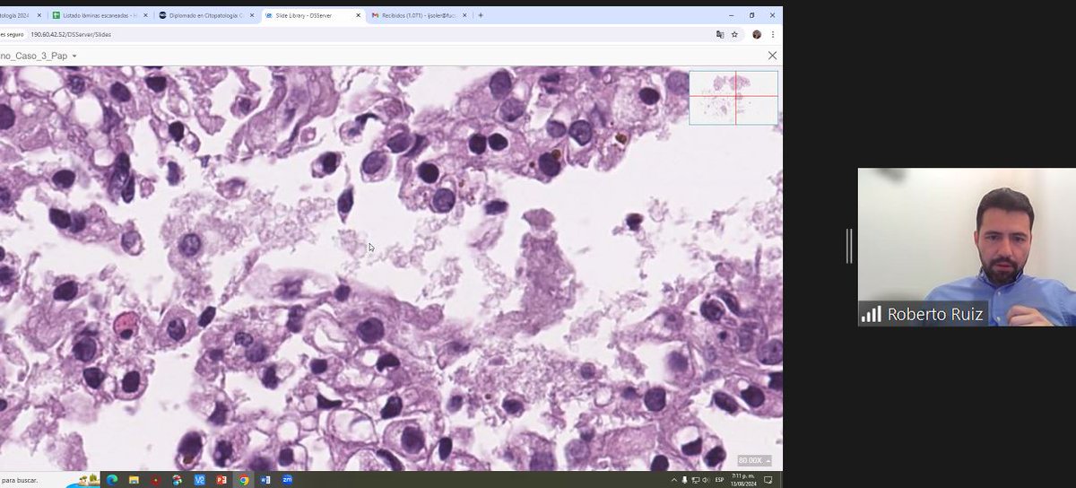 MonicaGarciaBu2's tweet photo. 22nd session International Cytology Training in Spanish. Cytology of Mediastinum @drruizcor sharing classic cases: EBV+ lymphoepith-like Ca, PAX8+ metastatic RCC @UMiamiPathology @MerceJorda1 @CarmenGomezMD @JaylouVelez @manuel_lg @IACytology @martin_poveda82 #FUCS #cyto https://t.co/pRzgLuGvIP