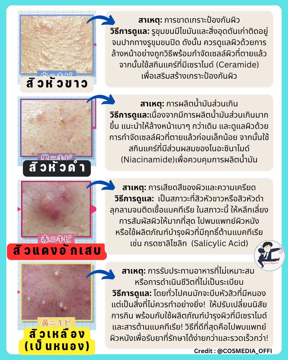 ไขทุกข้อสงสัยเรื่องสิวข้อมูลจากฟากฝั่งญี่ปุ่น เธรดนี้ยาวหน่อยนะ จะเล่าตั้งแต่ประเภทสิว 4 แบบ (แต่ละคนอาจเป็นสิวประเภทไม่เหมือนกัน), สาเหตุของการเกิดสิวแบบต่างๆ 

รวมถึงแนะนำวิธีการดูแลหลังจากเกิดสิวแล้ว วิธีล้างหน้าเพื่อไม่ให้เป็นสิว วิธีดูแลผิวหน้า ใครสนใจอ่านได้เลยครับ (1)👇