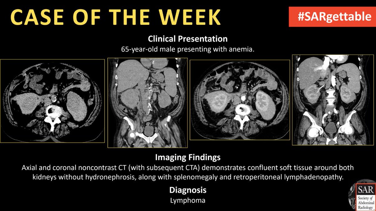 SocietyAbdRad's tweet photo. The answer to last week's #SARgettable Case of the Week is: Lymphoma. Thanks for playing! https://t.co/RH152ygrod