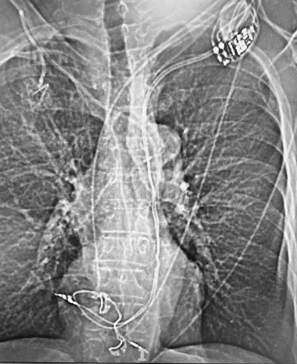 Paari Dominic (@drpaari) on Twitter photo Extracted this 10+ yr system out. Persistent LSVC. Snared the RV from femoral work station, straightened in the IVC, then tight-rail from the shoulder #EPeeps <a href="/rdschaller/">Robert Schaller</a> <a href="/SivaMulpuruMD/">Siva Mulpuru MD MPH</a> <a href="/RashadKhaziSyed/">Rashad Khazi Syed</a> <a href="/emichaelpowers/">Michael Powers</a> <a href="/UIowaCVFellows/">Univ of Iowa Cardiovascular Fellowship Program</a> <a href="/IntMedatIowa/">Internal Medicine at Iowa</a> Extracted this 10+ yr system out. Persistent LSVC. Snared the RV from femoral work station, straightened in the IVC, then tight-rail from the shoulder #EPeeps <a href="/rdschaller/">Robert Schaller</a> <a href="/SivaMulpuruMD/">Siva Mulpuru MD MPH</a> <a href="/RashadKhaziSyed/">Rashad Khazi Syed</a> <a href="/emichaelpowers/">Michael Powers</a> <a href="/UIowaCVFellows/">Univ of Iowa Cardiovascular Fellowship Program</a> <a href="/IntMedatIowa/">Internal Medicine at Iowa</a>