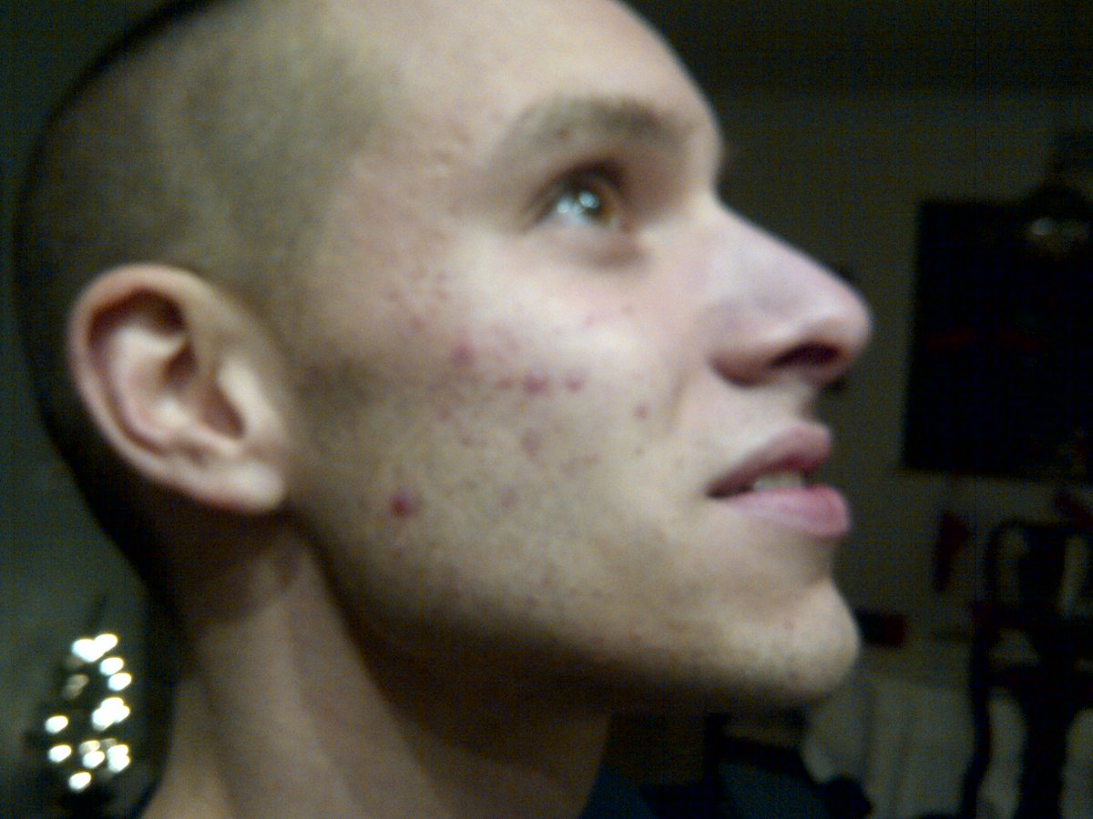 ProbioticAction's tweet image. 4 days using Probiotic Action topical probiotic, plus daily beach time. Note: The sun isn&apos;t always a friend to your skin. #Skincare #Probiotics #SunCare #BeforeAndAfter