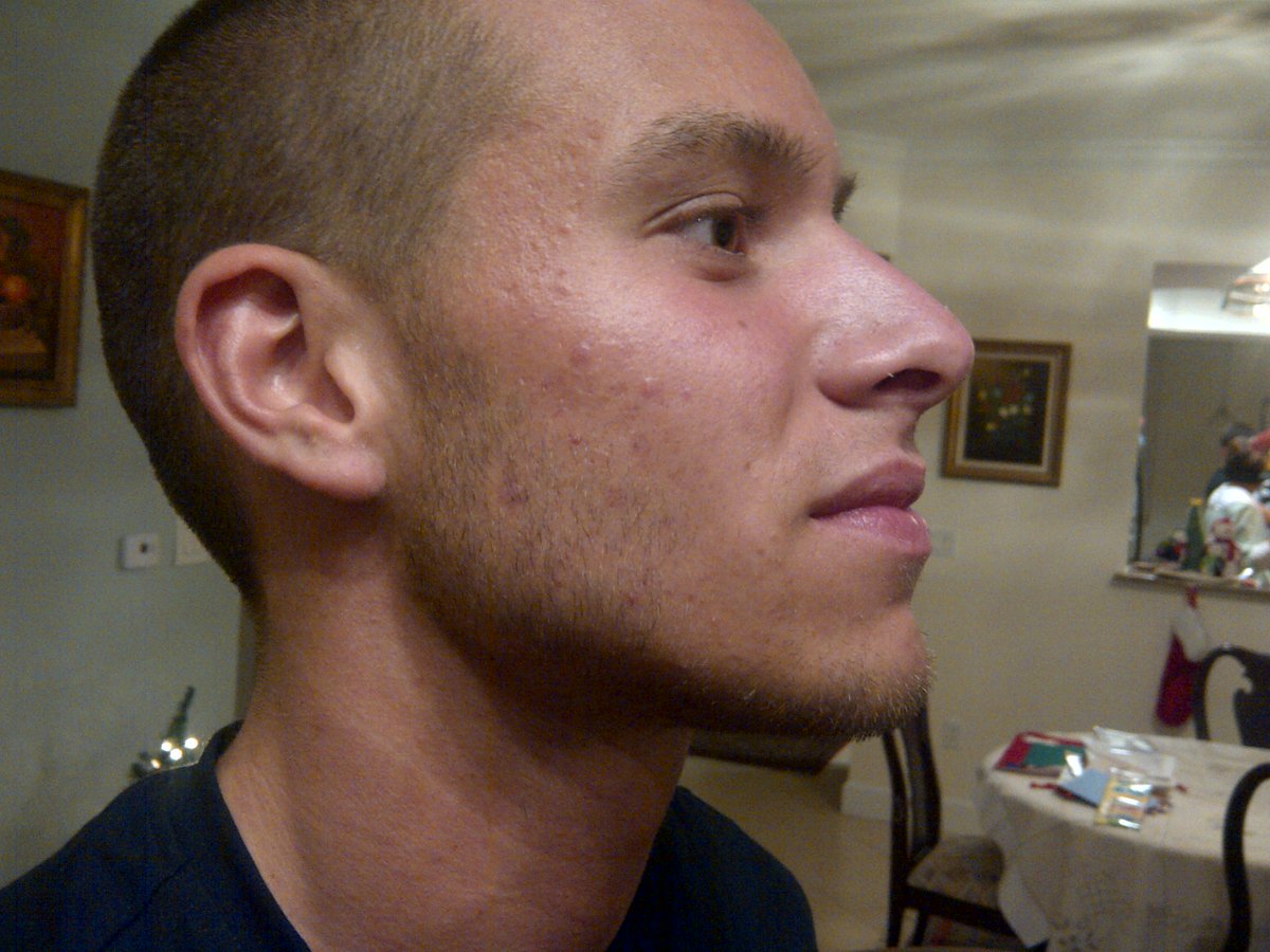 ProbioticAction's tweet image. 4 days using Probiotic Action topical probiotic, plus daily beach time. Note: The sun isn&apos;t always a friend to your skin. #Skincare #Probiotics #SunCare #BeforeAndAfter