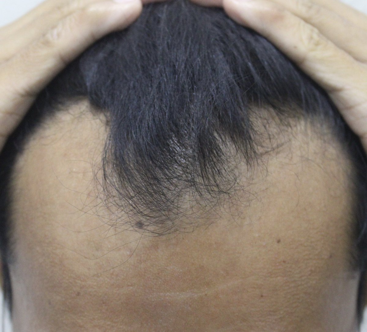 guillderm's tweet photo. Kaya pa naman mabawi ang hairline with just medications. Pwede din naman mag hair transplant but you will still need to take meds. 

⬇️ 7 months on medications only: finasteride/dutasteride + Oral Minoxidil 

Email posted on profile if you wanna know more https://t.co/XMz0ZZiwcT