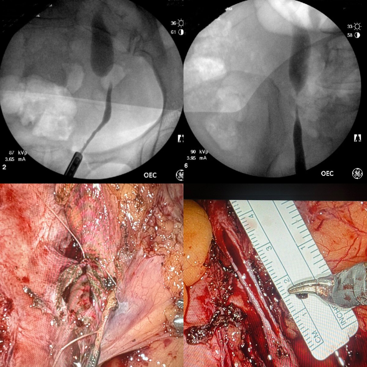 Maia VanDyke, MD (@maiasaurusrex) on Twitter photo Final verdict: non-transecting side-to-side reimplant on left, buccal ureteroplasty on right (5cm after final spatulation). No new ports or repositioning required, just ✈️ the bed. Great OR teams make the complex cases run smoothly 💪
<a href="/Allyhertz/">Alexandria Hertz</a> <a href="/SocietyGURS/">GURS</a> <a href="/SocietySURS/">Society of Urologic Robotic Surgeons (SURS)</a> Final verdict: non-transecting side-to-side reimplant on left, buccal ureteroplasty on right (5cm after final spatulation). No new ports or repositioning required, just ✈️ the bed. Great OR teams make the complex cases run smoothly 💪
<a href="/Allyhertz/">Alexandria Hertz</a> <a href="/SocietyGURS/">GURS</a> <a href="/SocietySURS/">Society of Urologic Robotic Surgeons (SURS)</a>