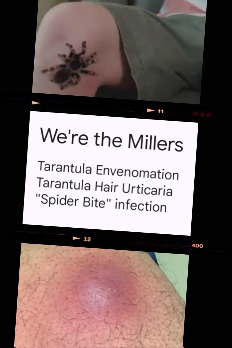 Season 2 of Medical Rewrites is here! 
S2 Episode 1 is We're the Millers. You know the scene. Kenny is bitten by a tarantula and gets IV antibiotics. A well deserved rewrite.
Apple: podcasts.apple.com/us/podcast/med…
Spotify: open.spotify.com/show/0XM3vd0pK…