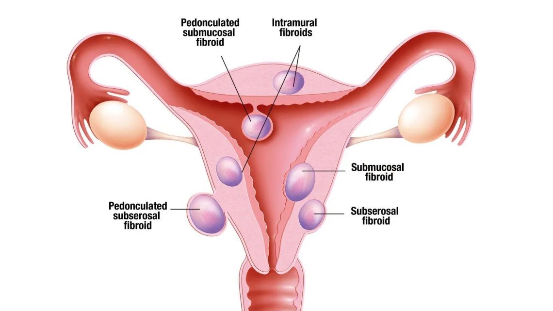 DrJohnBishop's tweet photo. Myth 3: Lack of Pregnancy causes Fibroid.
Fact: This is simply not true. The exact cause of uterine fibroids is not fully understood, but several factors are believed to contribute to their development:

- Hormones: Oestrogen and progesterone, the hormones that regulate the menstrual cycle, appear to promote the growth of fibroids.

- Genetics: A family history of fibroids increases the likelihood of developing them.
- Other factors: Obesity, early onset of menstruation, and certain dietary factors MAY also play a role in fibroid development.

Myth 4: All Fibroids are the same

Fact: Fibroids can vary widely in size, location, and type. They can grow inside the uterine wall (intramural), on the outer surface of the uterus (subserosal), or under the inner lining of the uterus (submucosal). The type and location of fibroids can affect the symptoms and treatment options.