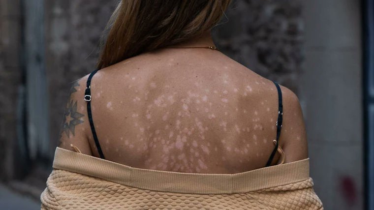 🌟 Los avances en tratamientos permiten una recuperación total de la psoriasis en el 50% de los casos. En España, más de 1 millón de personas enfrentan esta enfermedad cutánea 

abc.es/salud/avances-… vía <a href="/abc_salud/">abc_salud</a>