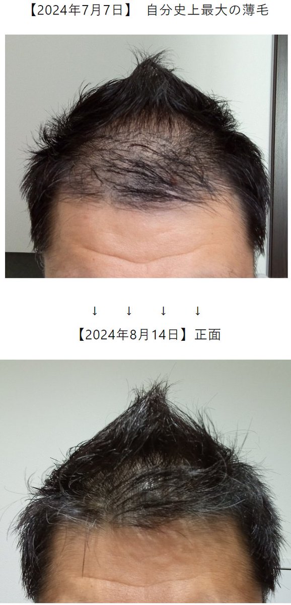 MinatoYukiya's tweet photo. すごい、約一か月でハゲ脱出！生えてくるの信じていたけど、このまま一か月前の 「the ハゲ」だったらどうしよ、、、と思っていた。よかった　よかった。

https://t.co/eTEsRIi1p6

#育毛 #薄毛 #発毛 https://t.co/026TiajZPn