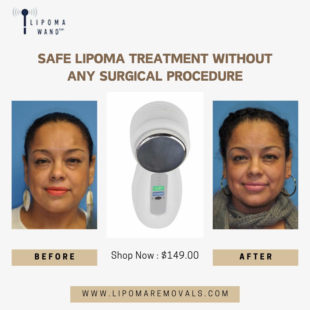 Experience safe and effective lipoma treatment with Lipoma Wand! No need for surgery—our innovative solution helps reduce the appearance of lipomas naturally and painlessly.

Visit the website: lipomaremovals.com

Call us: +805 277 9092

#Health #Lipoma #Skincare #Fattylumps