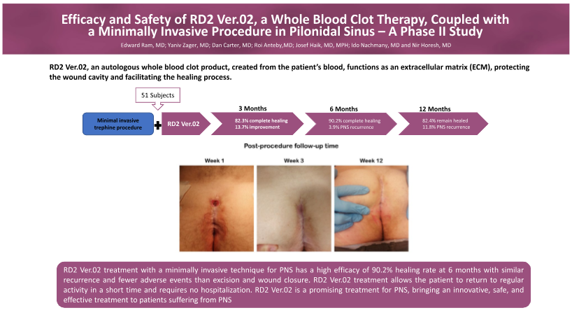 Nir Horesh (@nirhoresh) on Twitter photo New pub - RD2 Ver.02 (Actigraft), a novel whole blood clot therapy, shows promise in treating pilonidal sinus with minimally invasive procedures. 82.4% of patients achieved healing within 3 months - rdcu.be/dQSbe
<a href="/SWexner/">Steven D Wexner MD, PhD</a> <a href="/dr_samehhany81/">Sameh Emile, MD, FACS</a> <a href="/TechColoproctol/">Techniques in Coloproctology Journal</a> <a href="/sheba_medical/">Sheba Medical Center</a> New pub - RD2 Ver.02 (Actigraft), a novel whole blood clot therapy, shows promise in treating pilonidal sinus with minimally invasive procedures. 82.4% of patients achieved healing within 3 months - rdcu.be/dQSbe
<a href="/SWexner/">Steven D Wexner MD, PhD</a> <a href="/dr_samehhany81/">Sameh Emile, MD, FACS</a> <a href="/TechColoproctol/">Techniques in Coloproctology Journal</a> <a href="/sheba_medical/">Sheba Medical Center</a>