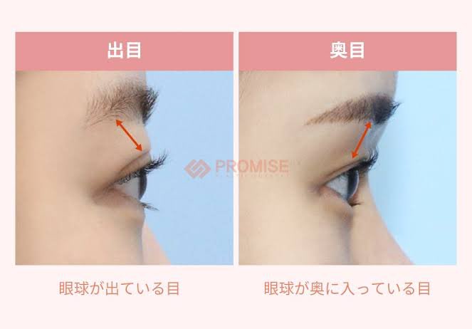 出目と奥目