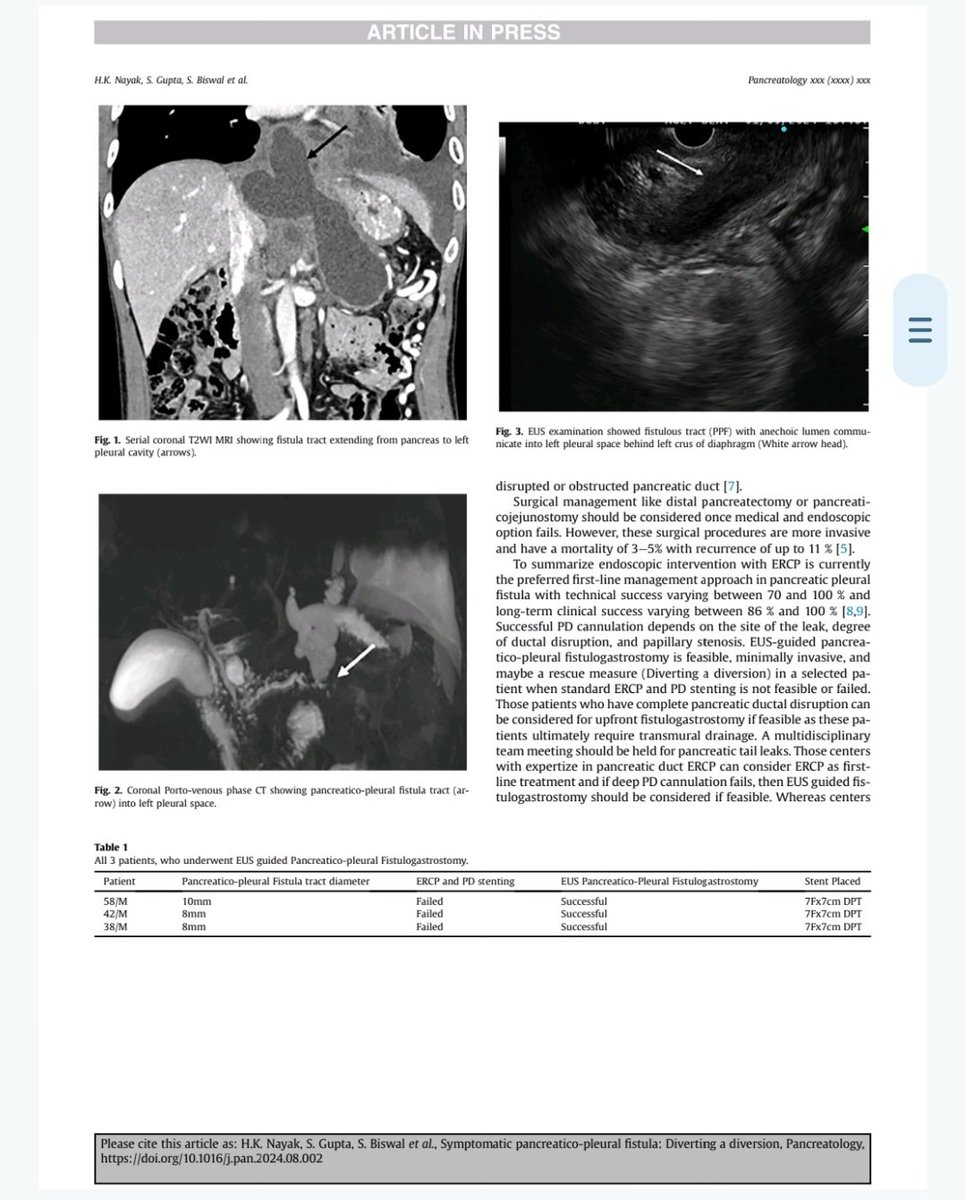 HemantakNayak1's tweet photo. Symptomatic Pancreatico-pleural fistula with failed transpapillary failed PD stenting:EUS guided Pancreatico-Pleural fistulogastrostomy as  rescue, our case series of 3 cases, recently published in Pancreatology https://t.co/ccmXtP9nmZ