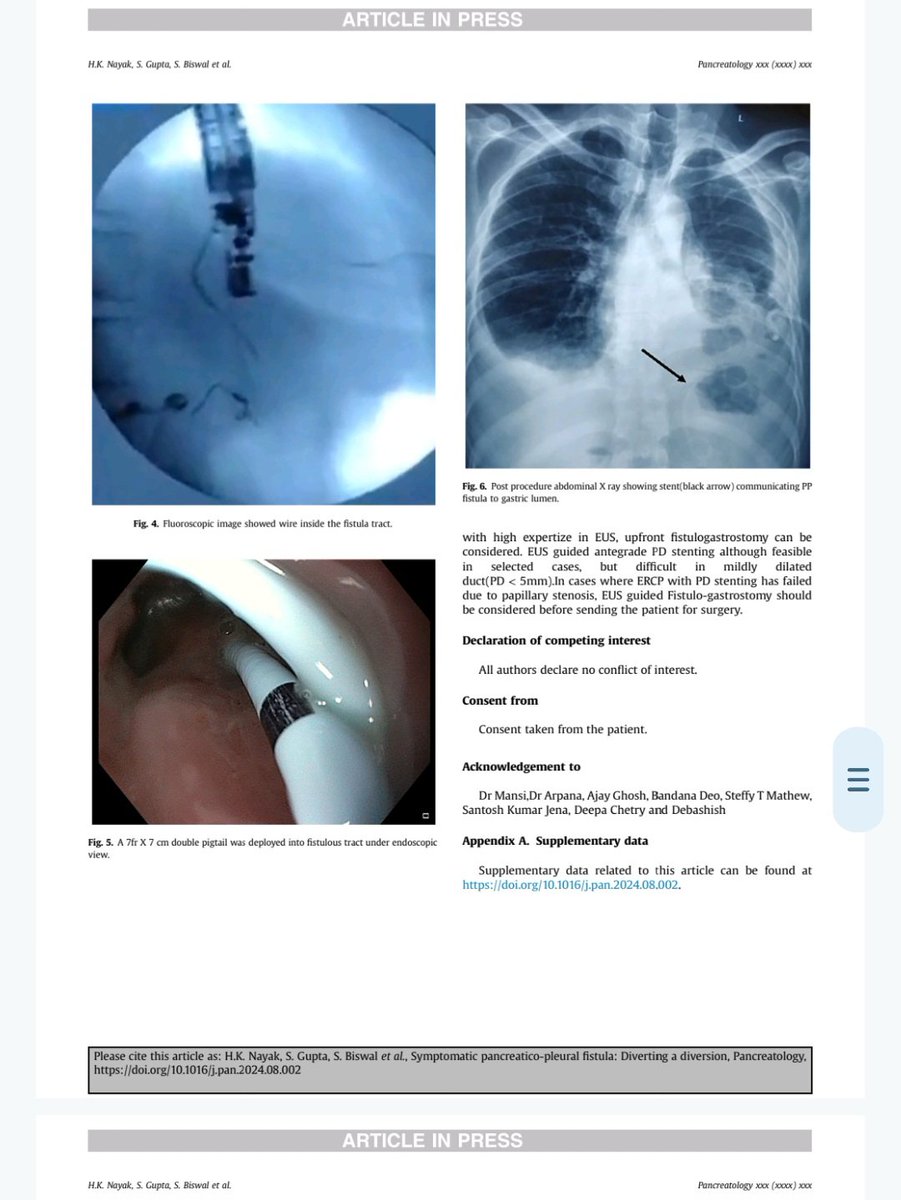 HemantakNayak1's tweet photo. Symptomatic Pancreatico-pleural fistula with failed transpapillary failed PD stenting:EUS guided Pancreatico-Pleural fistulogastrostomy as  rescue, our case series of 3 cases, recently published in Pancreatology https://t.co/ccmXtP9nmZ