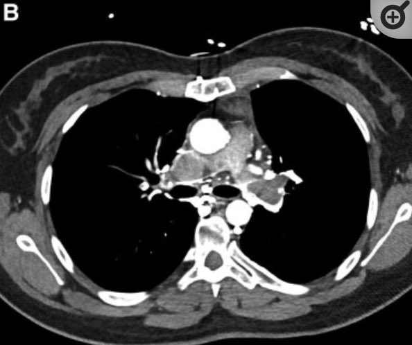 ISACHD's tweet image. Sharing our @ISACHD #CaseOfTheMonth

A case of succesful #transcatheter #thrombectomy in a 28-year-old adult with #Fontan circulation. 

doi:10.1093/ehjcr/ytad401

tinyurl.com/bdeb5n3n