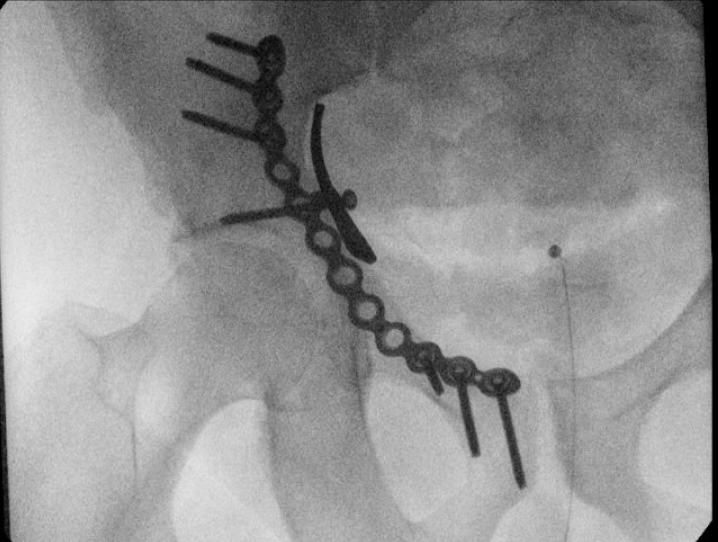 ImperialNHS's tweet photo. 📣 On Monday, Orthopaedic surgeons at St Mary’s Hospital became the first in Europe to successfully implant a new and innovative plate to fix a fracture of a patient’s pelvis. 
 
The Stryker Trauma Pelvic Suprapectineal Flex Plate was only released in Europe last week! 
 
1/2 https://t.co/z5cGgctZKl