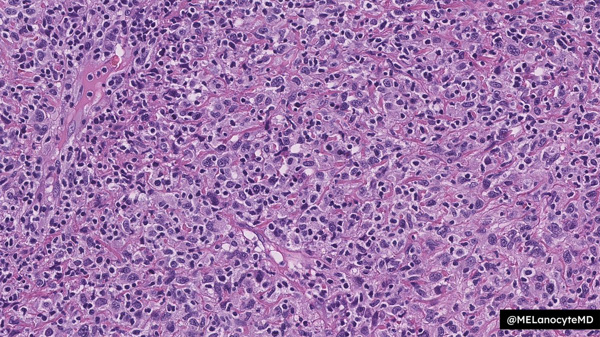MELanocyteMD's tweet photo. 68♂️ w/ lytic femur mass

Is it...
1️⃣ Sarcoma?
2️⃣ Melanoma?
3️⃣ Carcinoma?
4️⃣ Lymphoma?

🔎WSI: https://t.co/yRWzPoBIoH
�� Answer: https://t.co/DYopSOSZWe

#BSTpath (...or is it? 🤔) https://t.co/rBVD0UFkq5