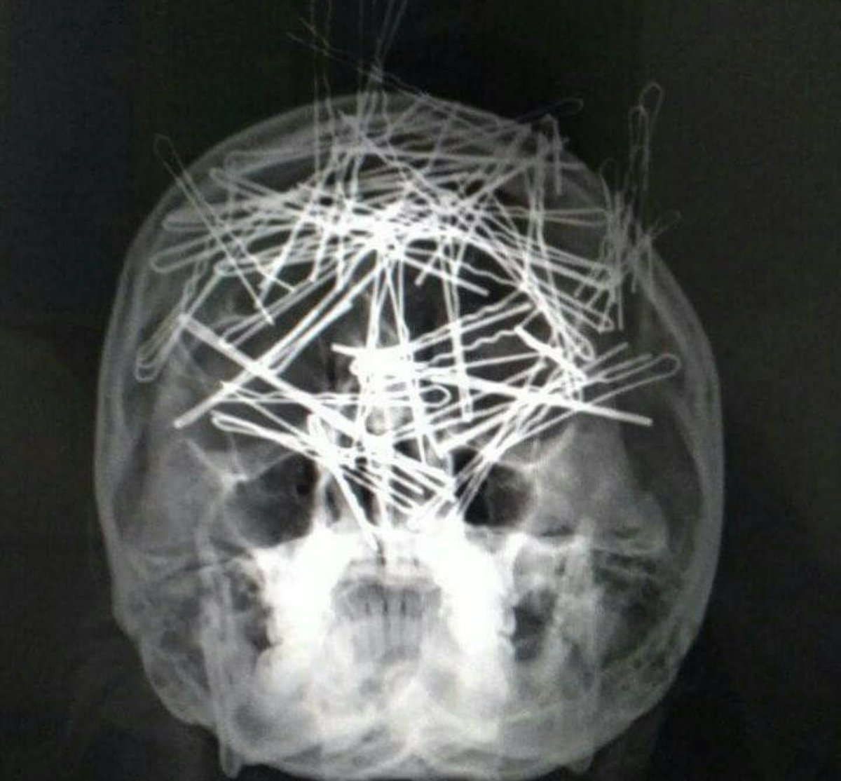 Oren Gottfried, MD tweet media