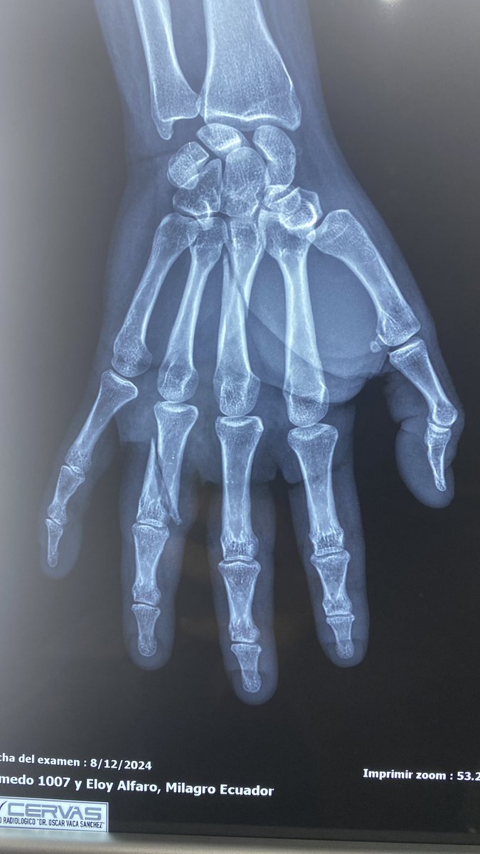 traumacenterec's tweet photo. Fracturas de la mano. Por mecanismo de torsión. Quieren saber cómo lo resolvimos? https://t.co/S9qylu3XXK