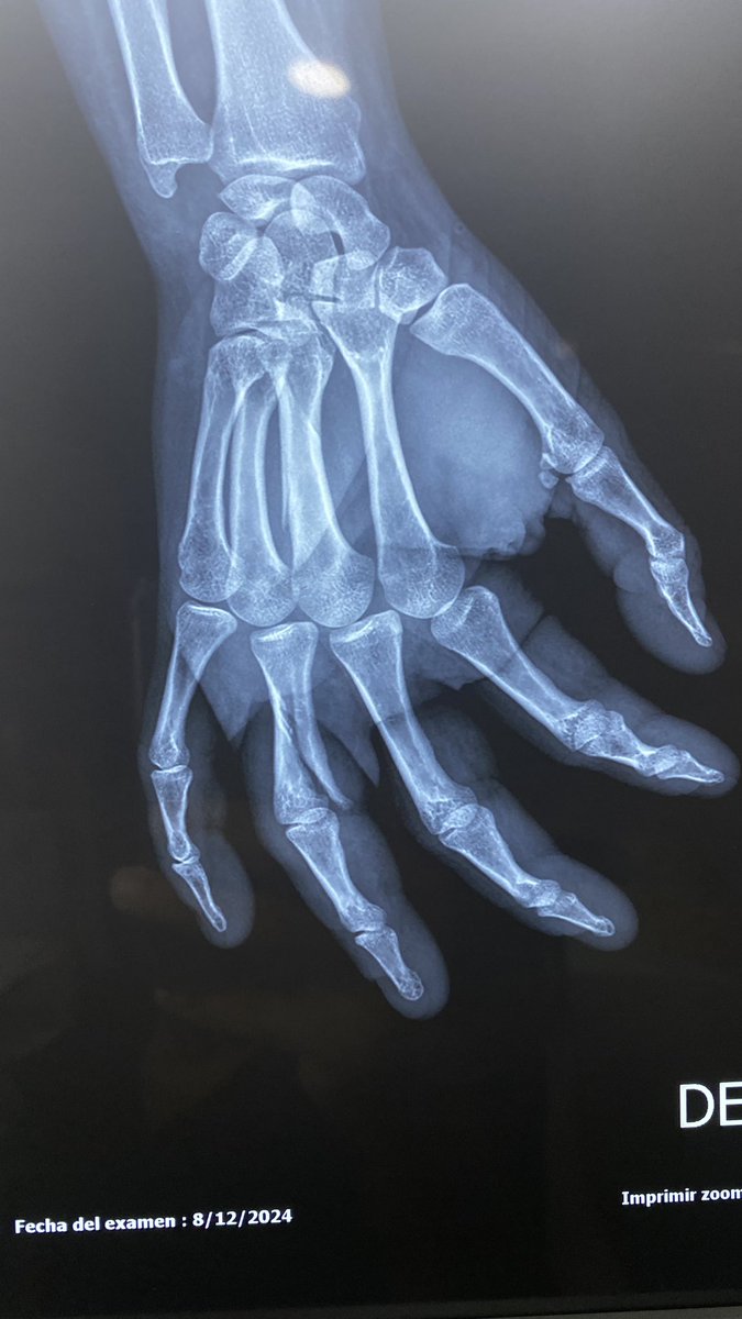 traumacenterec's tweet photo. Fracturas de la mano. Por mecanismo de torsión. Quieren saber cómo lo resolvimos? https://t.co/S9qylu3XXK