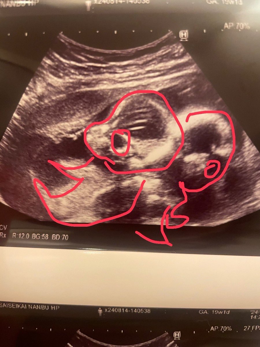 mekeko87's tweet image. 性別はまだ分からなかったけど
今日は二人収めたエコー写真が
貰えた- ̗̀(*˘ᵕ˘*)˘ᵕ˘*) ̖́-

背中合わせ👶👶

動いてるとまだ分かるけど
写真になると訳分からない😂

無事に育て～～🌷🫧

 #19w
 #双子マタ