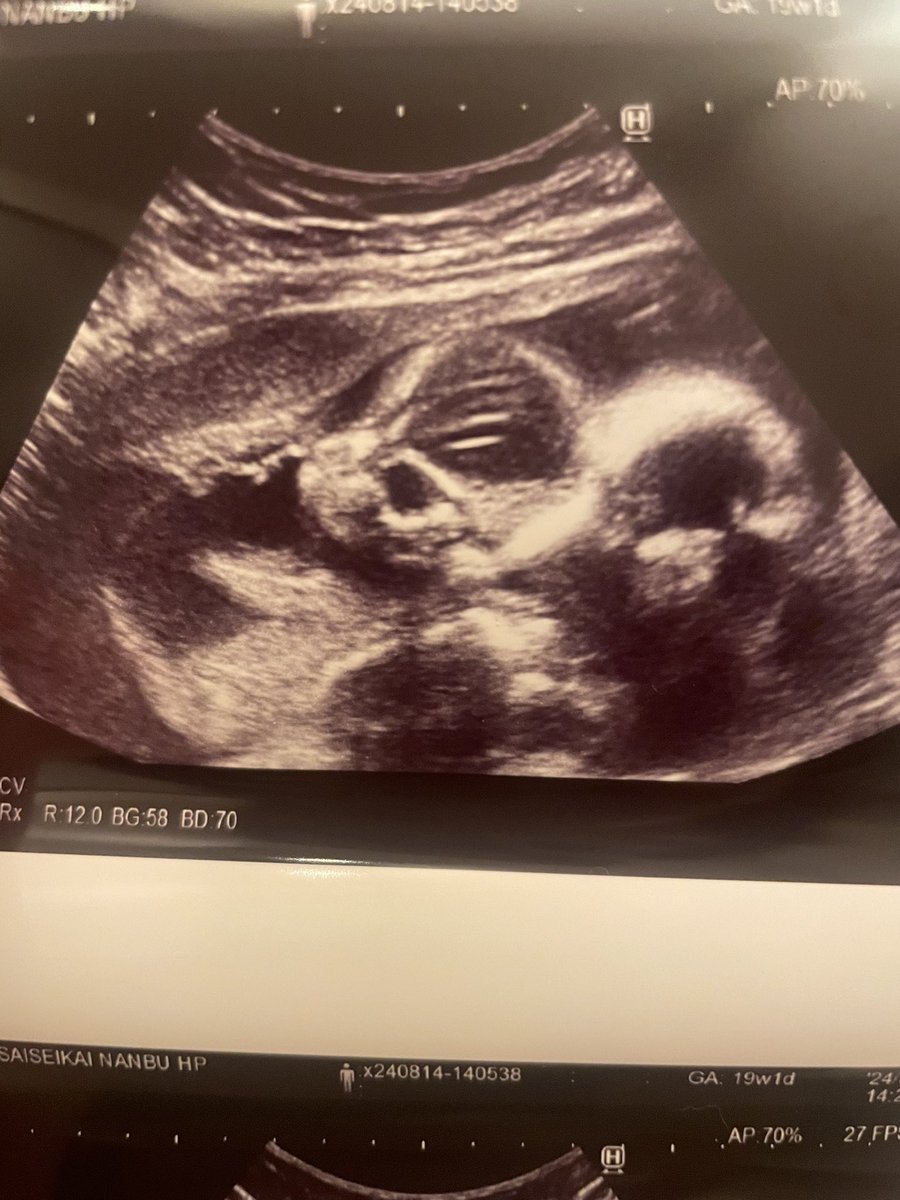 mekeko87's tweet image. 性別はまだ分からなかったけど
今日は二人収めたエコー写真が
貰えた- ̗̀(*˘ᵕ˘*)˘ᵕ˘*) ̖́-

背中合わせ👶👶

動いてるとまだ分かるけど
写真になると訳分からない😂

無事に育て～～🌷🫧

 #19w
 #双子マタ