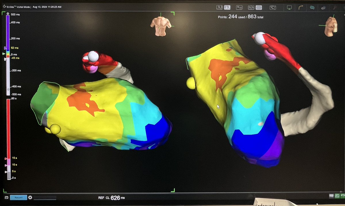 Preston Segars (@segarspr) on Twitter photo Great first case with <a href="/adegbala/">Adegbala Oluwole</a> at North Alabama Medical Center. Patient presented with PVC originating from the GCV. Mapping in the CS showed the earliest site to be -44ms with a 98% pacemap. HNS through #tactiflex was used to effectively treat the SOO. <a href="/AbbottCardio/">Abbott Cardiovascular</a> #epeeps Great first case with <a href="/adegbala/">Adegbala Oluwole</a> at North Alabama Medical Center. Patient presented with PVC originating from the GCV. Mapping in the CS showed the earliest site to be -44ms with a 98% pacemap. HNS through #tactiflex was used to effectively treat the SOO. <a href="/AbbottCardio/">Abbott Cardiovascular</a> #epeeps