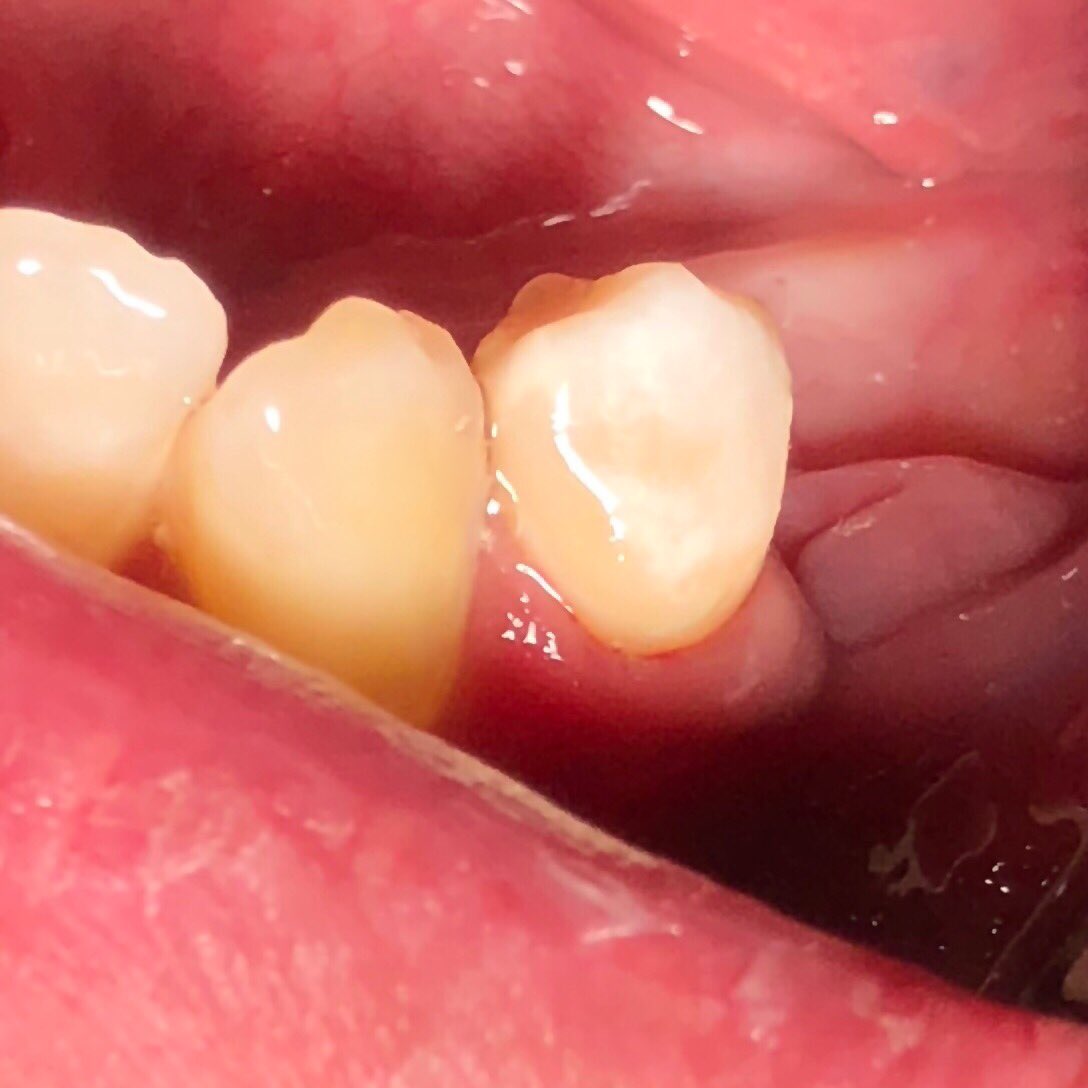 Resto. Case 🦷 ✨ 

تسوس على الأسنان 33  و 34 
تم علاجها بحشوات تجميلية 
(class V)

Teeth 33 and 34 with cervical caries 
Treated by class V composite restorations