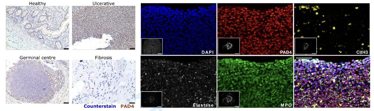 The Impact of #PAD4-dependent Neutrophil Extracellular Trap #NAT Formation on the Early Development of Intestinal #Fibrosis in #CD <a href="/GabrieleDragoni/">Gabriele Dragoni</a> <a href="/SeverineVermei1/">Severine Vermeire</a> <a href="/kebojun/">Bo-Jun Ke</a> @tommaso_innocenti <a href="/gmatteoli1978/">Gianluca Matteoli</a> <a href="/bverstockt/">Bram Verstockt</a> <a href="/DhooreAndre/">andre dhoore</a> <a href="/bisle84/">Gabriele Bislenghi</a> 

academic.oup.com/ecco-jcc/advan…