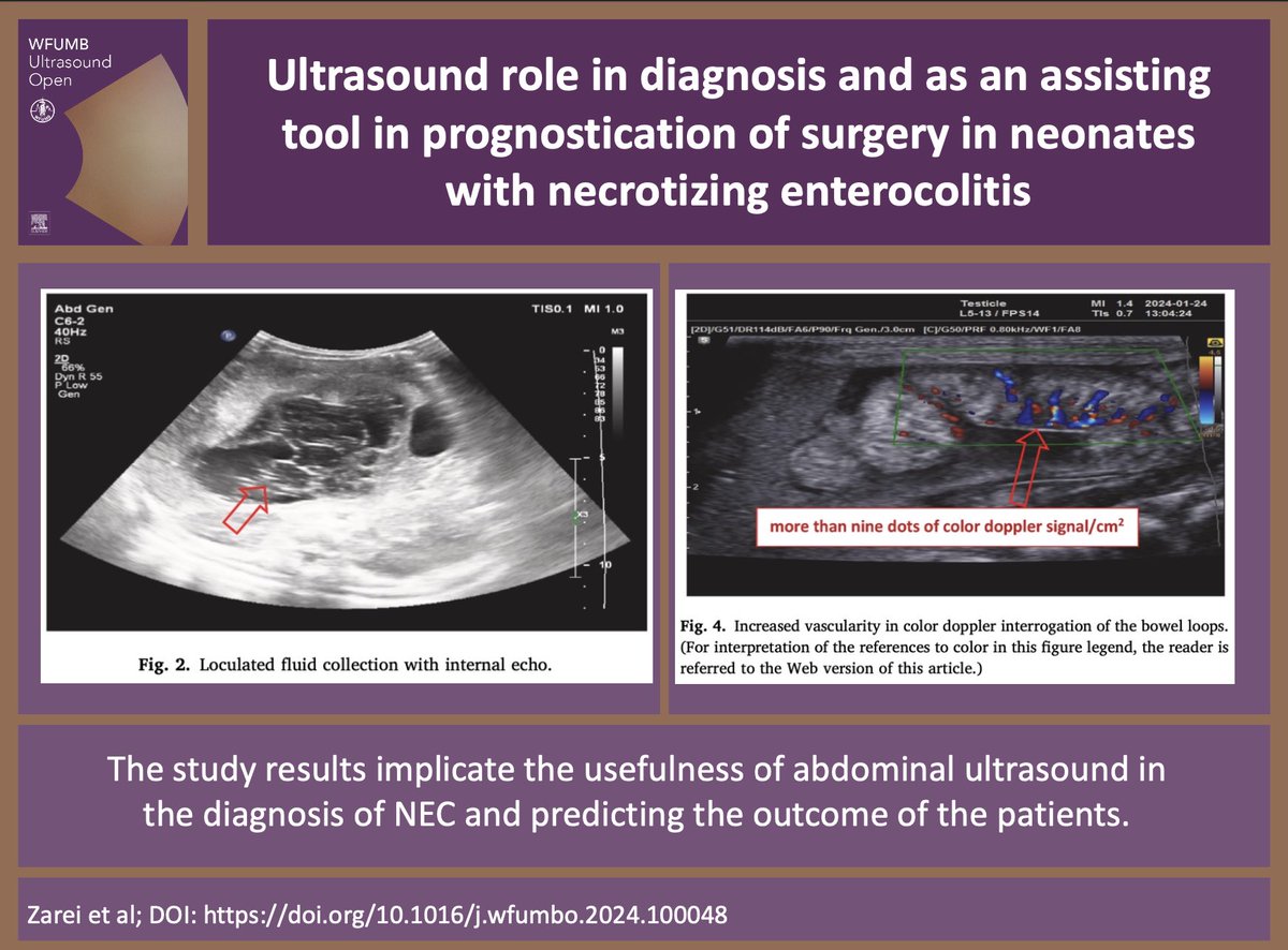WFUMBOpen's tweet photo. 📄Ultrasound role in diagnosis and as an assisting tool in prognostication of surgery in neonates with necrotizing enterocolitis📄

Elham Zarei et al

Read it at: https://t.co/ABDAU3F5cA

Submit your article at: https://t.co/Ib6dijnbR0

#Ultrasound #Sonography #Neonate #surgery https://t.co/pYhzLQdFyU