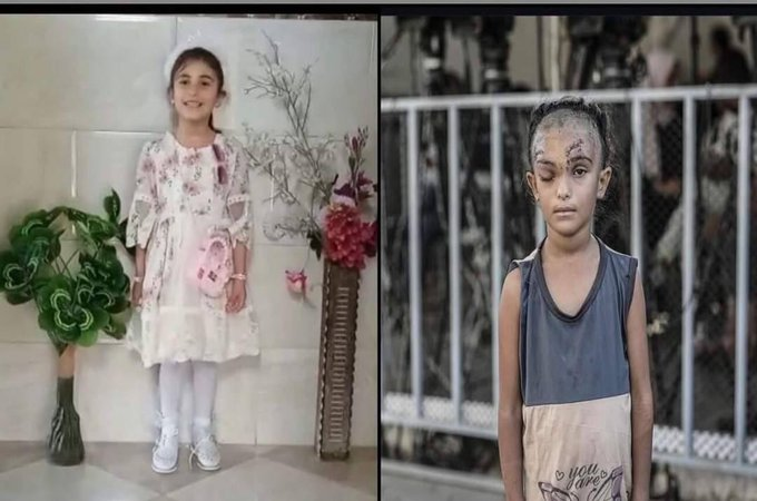 S24902053Saraya's tweet photo. The seven-year-old Palestinian girl Sila was injured with a fractured skull and a torn retina following an Israeli airstrike that targeted a school. Israel targeted the school with American bombs
#GazaGenocide #loveIsland #JO1 #fblosc #LeafsForever #üzüntüm #Stonehenge https://t.co/HXE6gV4kA6