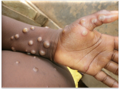 MarioNawfal's tweet photo. 🚨BREAKING: WHO DECLARES GLOBAL HEALTH EMERGENCY OVER MPOX OUTBREAK

The WHO has declared a global health emergency as Mpox, previously known as monkeypox, spreads rapidly across 13 African countries, including the DRC, where 14,000 cases and 524 deaths have been reported.

This marks the second time in three years Mpox has reached emergency status.

Source: The New York Times