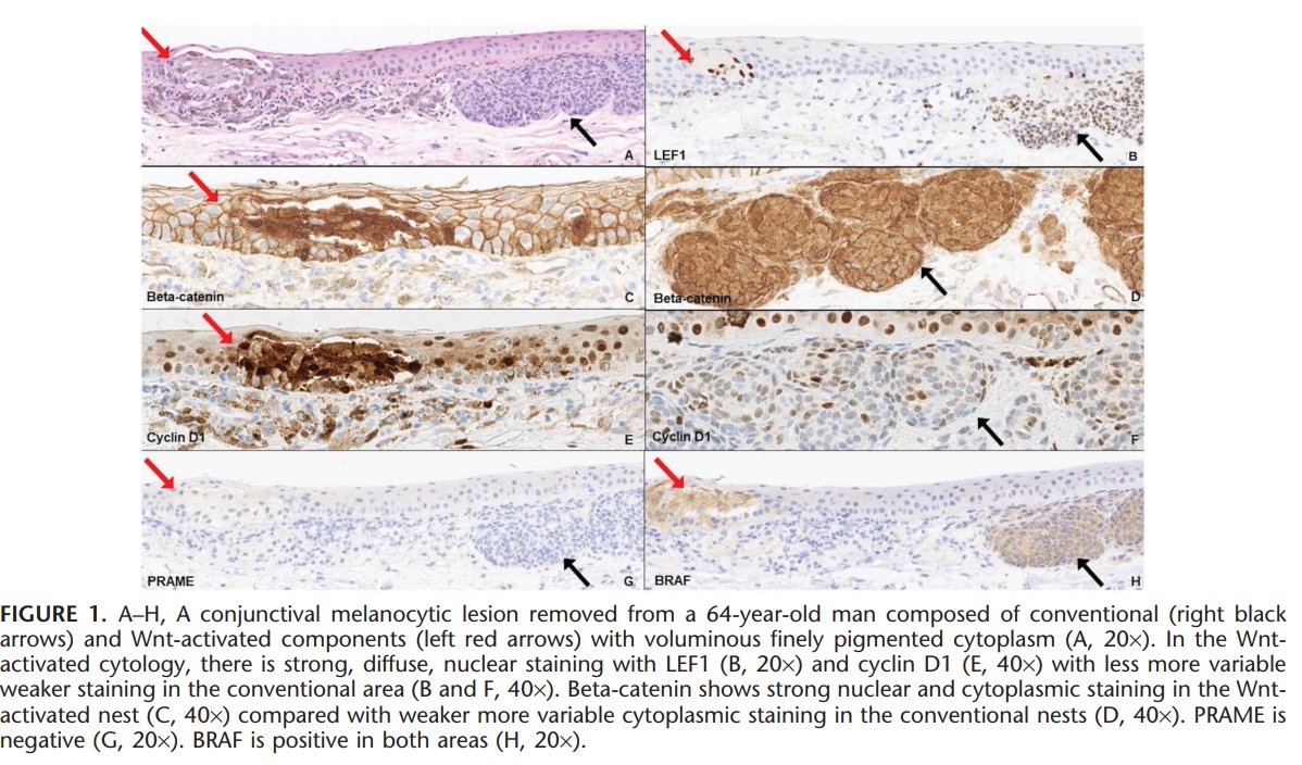 KonstantinosLin's tweet photo. Our new work. Superficial Wnt-activated melanocytic nevi/melanocytomas with a junctional component. American Journal of Dermatopathology
#pathology #dermatology #melanocytic https://t.co/EIEDvtlLWK