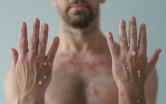 #MaymunÇiçeği

İnşAllah kovid’deki gibi geç kalmadan tedbirleri alırsınız. Özellikle Asya ve Afrika’dan uçuşlar durdurulmalıdır!