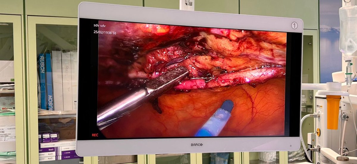 GConcistre's tweet photo. Thoracoscopic harvesting of left mammary artery in minimally invasive myocardial revascularitation
#midcab #myocardialrevascularitation #cabg #minimallyinvasive #cardiacsurgery #cardiology
@opa_massa https://t.co/pSAg9yxwUy