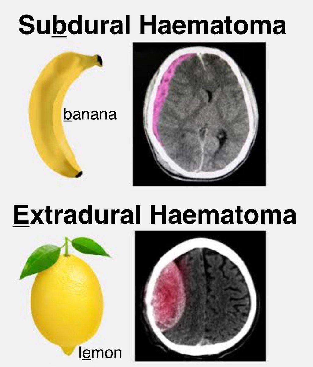 Using fruit to remember subdural vs extradural haematomas 🍌🍋