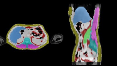 Evaluating Sex-specific Differences in Abdominal Fat Volume and Proton Density Fat Fraction on MRI Scans Using Automated nnU-Net-based Segmentation doi.org/10.1148/ryai.2… <a href="/MingmingWu10/">Mingming Wu</a> <a href="/BMRRgroup/">BMRR</a> #nnUNet #ML #MachineLearning