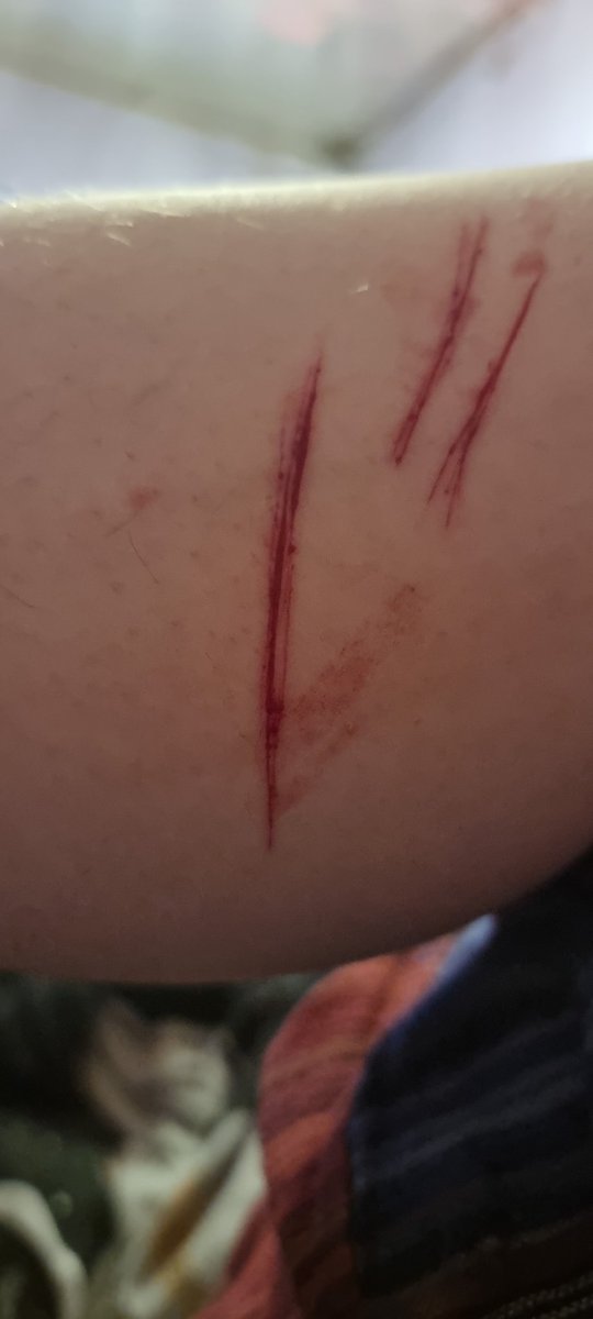 SlimWannabe's tweet photo. relapsed after 6 months oops
#shtwt https://t.co/PjT5v4LhCE
