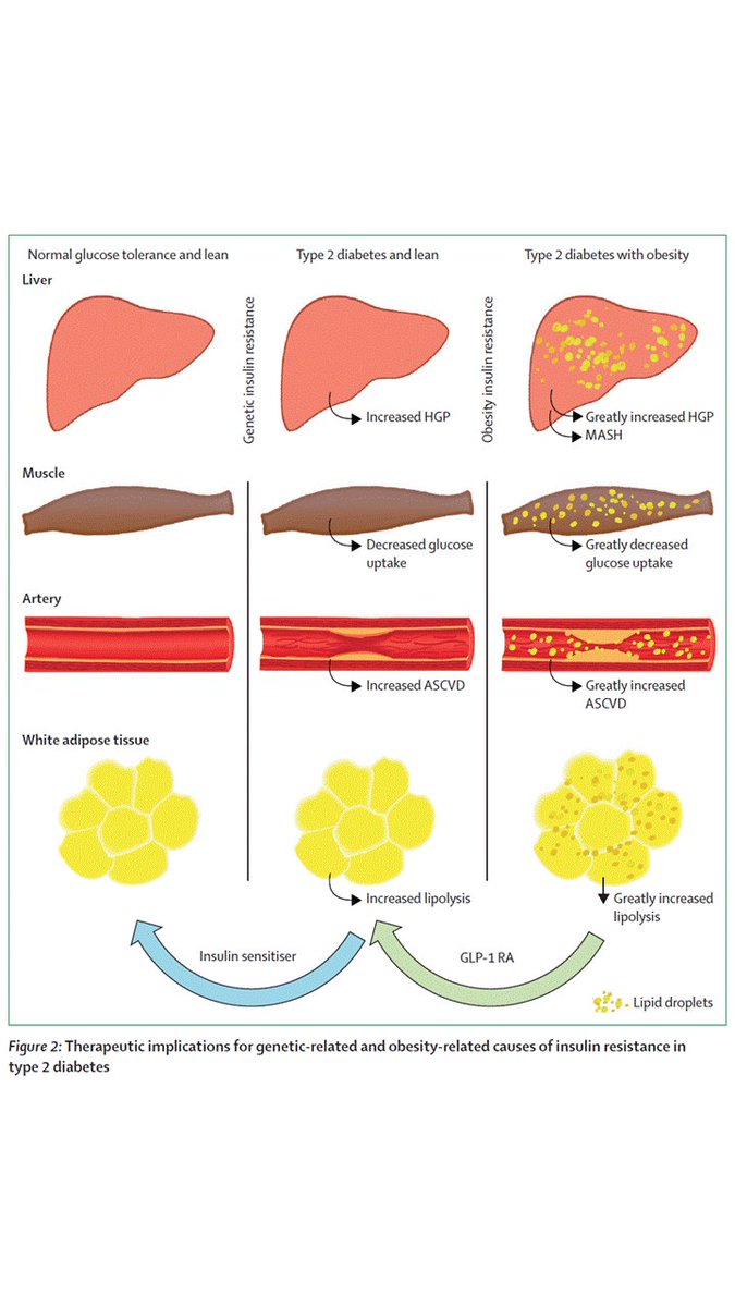 Norbert Stefan (@drnorbertstefan) on Twitter photo In <a href="/TheLancetEndo/">The Lancet Diabetes & Endocrinology</a> Prof. DeFronzo & colleagues highlight the importance of managing insulin resistance, particularly in lean people with #type2diabetes. In <a href="/TheLancetEndo/">The Lancet Diabetes & Endocrinology</a> Prof. DeFronzo & colleagues highlight the importance of managing insulin resistance, particularly in lean people with #type2diabetes.